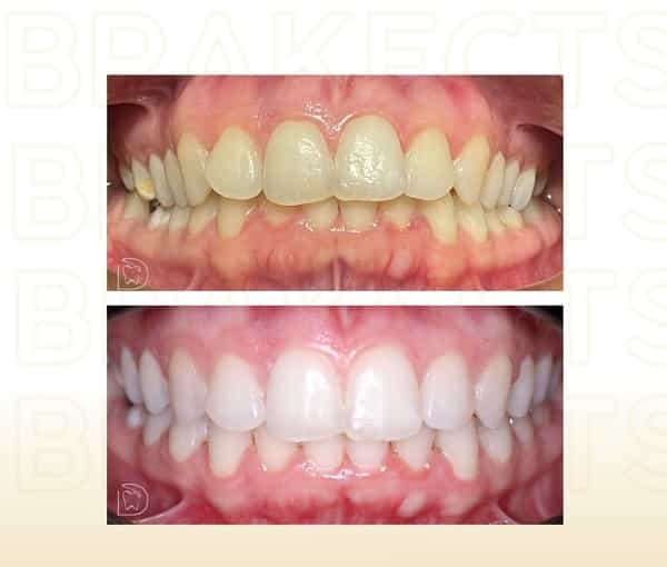 Before After Images Dental Treatments in Cancun Mexico
