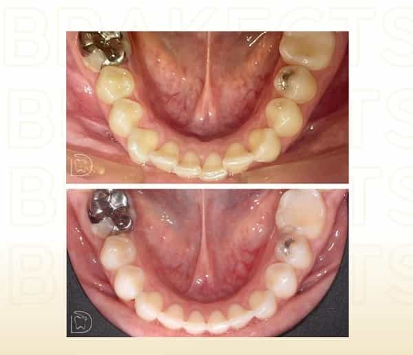 Before After Images Dental Care in Cancun Mexico
