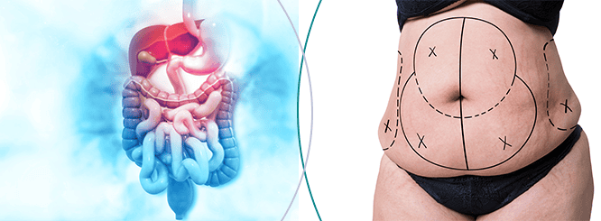 Bariatric Surgery Or Liposuction
