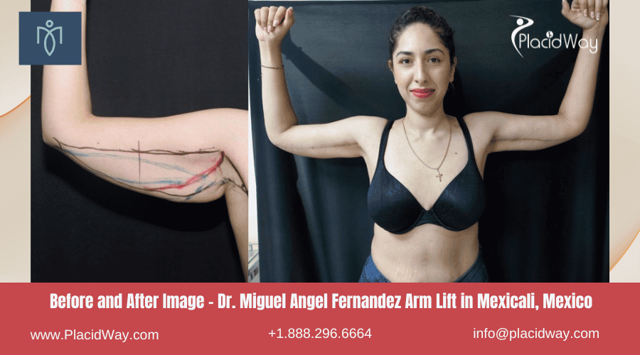 Arm Lift in Mexicali, Mexico by Dr. Miguel Angel Fernandez Before After Images