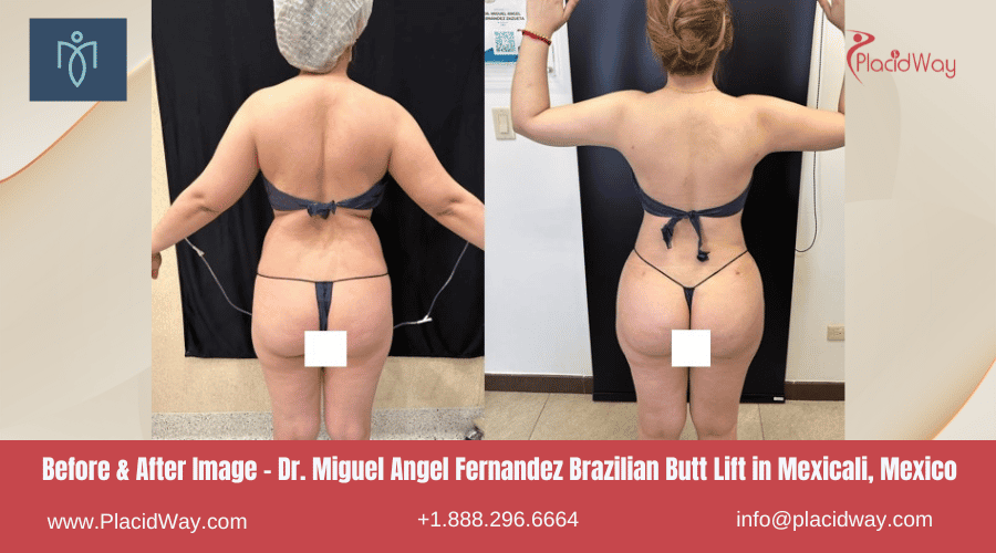 BBL in Mexicali, Mexico by Dr. Miguel Angel Fernandez Before After Images