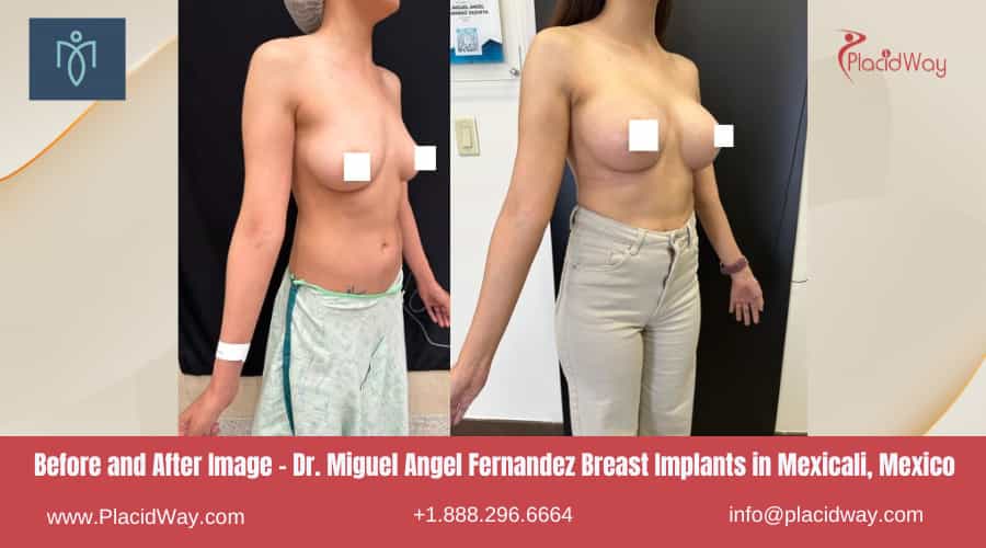 Before and After Image - Breast Implants in Mexicali, Mexico by Dr. Miguel Angel Fernandez 
