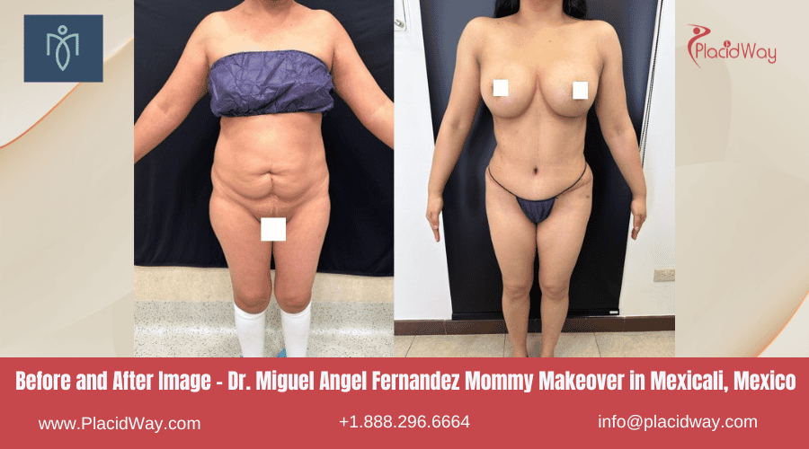 Before After Images for Mommy Makeover in Mexicali, Mexico by Dr. Miguel Angel Fernandez
