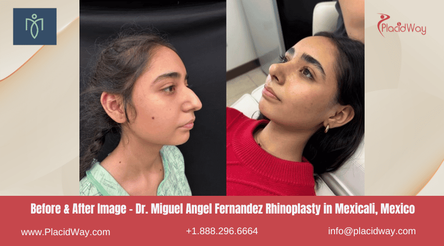 Rhinoplasty in Mexicali, Mexico by Dr. Miguel Angel Fernandez Before After Image
