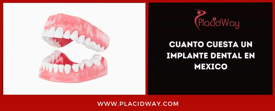 Cuanto Cuesta Un Implante Dental En Mexico