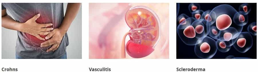 GIOSTAR Hospital Bengaluru India FAQs - Crohns, Scieroderma