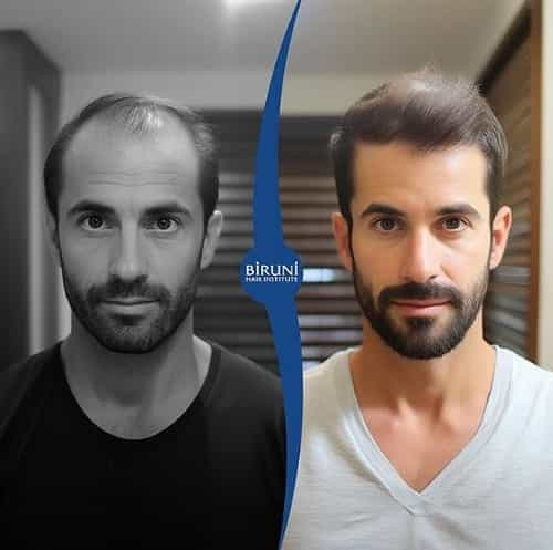 Biruni Hair Institute Istanbul Turkey Before After Image