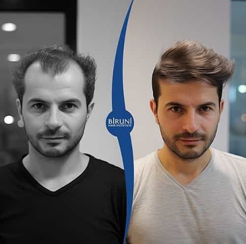 Before After Image at Biruni Hair Institute in Istanbul Turkey