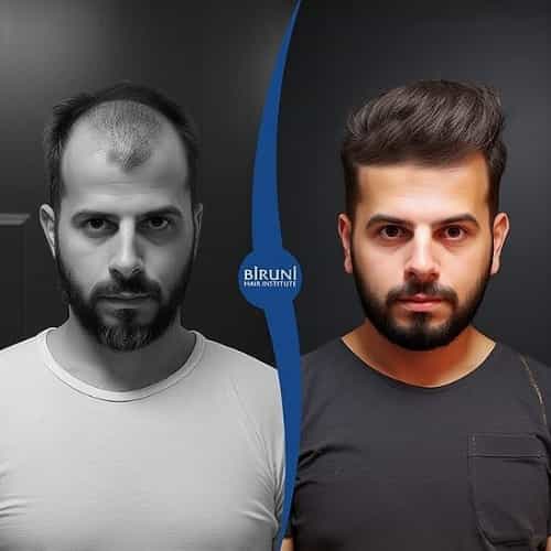 Before After Image at Biruni Hair Transplantation in Istanbul Turkey