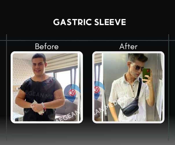 Before and After Results of Gastric Sleeve Izmir Turkey