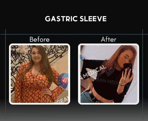 Before and After Gastric Sleeve Izmir Turkey