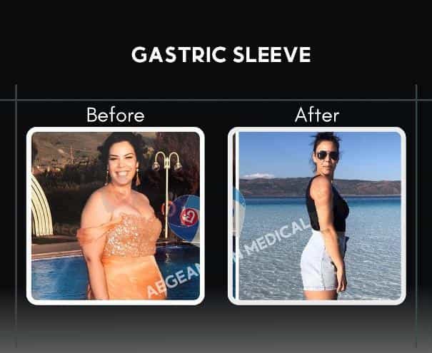 Gastric Sleeve Izmir Turkey Before After Image