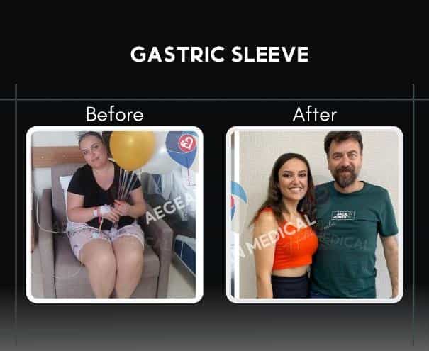 Gastric Sleeve Izmir Turkey Before After Picture