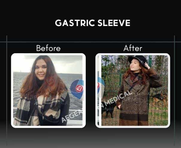 Before After Image of Gastric Sleeve Izmir Turkey