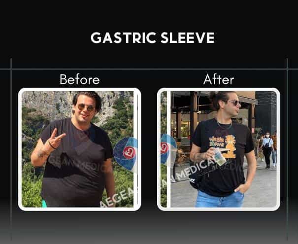 Gastric Sleeve Surgery in Izmir Turkey Before After