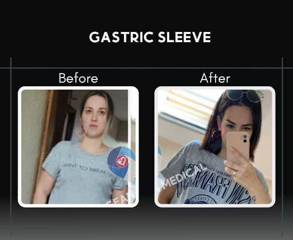 Before and After Gastric Sleeve in Izmir Turkey by Dr. Cemal