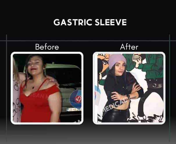 Before and After Sleeve Gastrectomy in Izmir Turkey