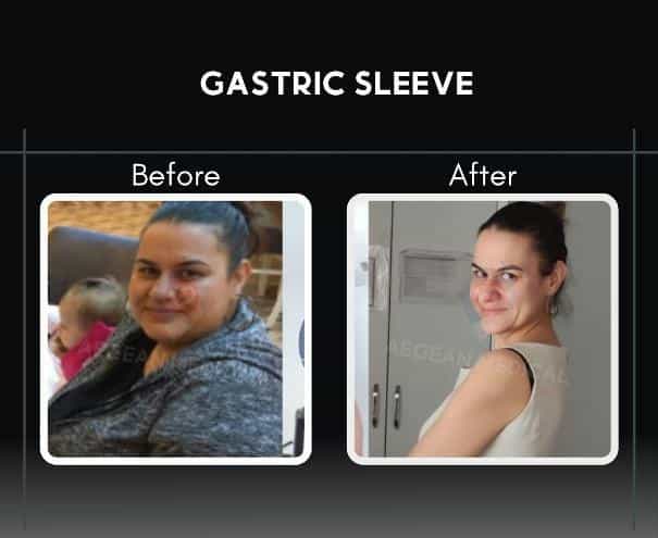 Sleeve Gastrectomy in Izmir Turkey Before and After Image
