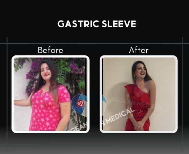 Sleeve Gastrectomy in Izmir Turkey Before and After Picture