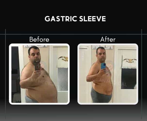 Sleeve Gastrectomy in Izmir Turkey Before After Image