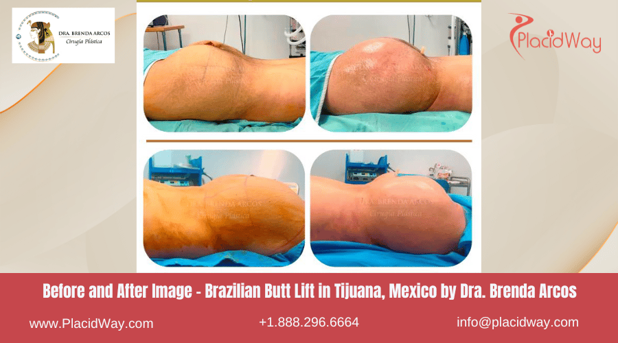 BBL in Tijuana Mexico by Dra Brenda Arcos