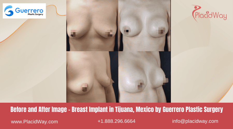 Breast Augmentation in Tijuana Mexico - Guerrero