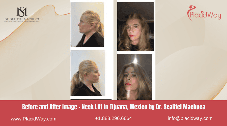 Neck Lift in Tijuana Mexico - Dr Sealtiel