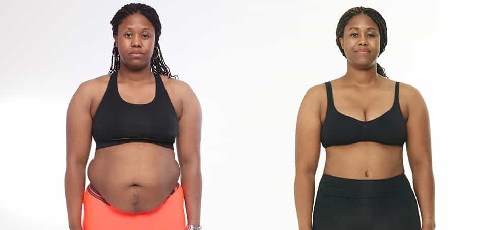 Before and After of  Body Surgery in Seoul, South Korea