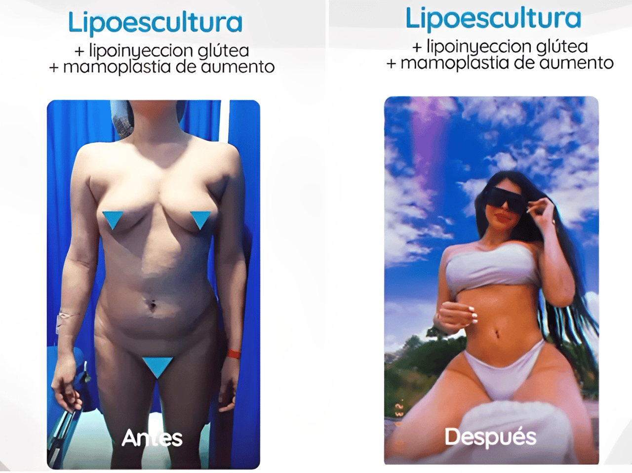 Mommy Makeover Colombia Package by Dr. Uribe