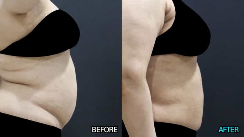 plastic surgery in seoul south korea before after