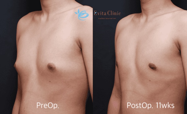 gynecomastia in seoul south korea before after
