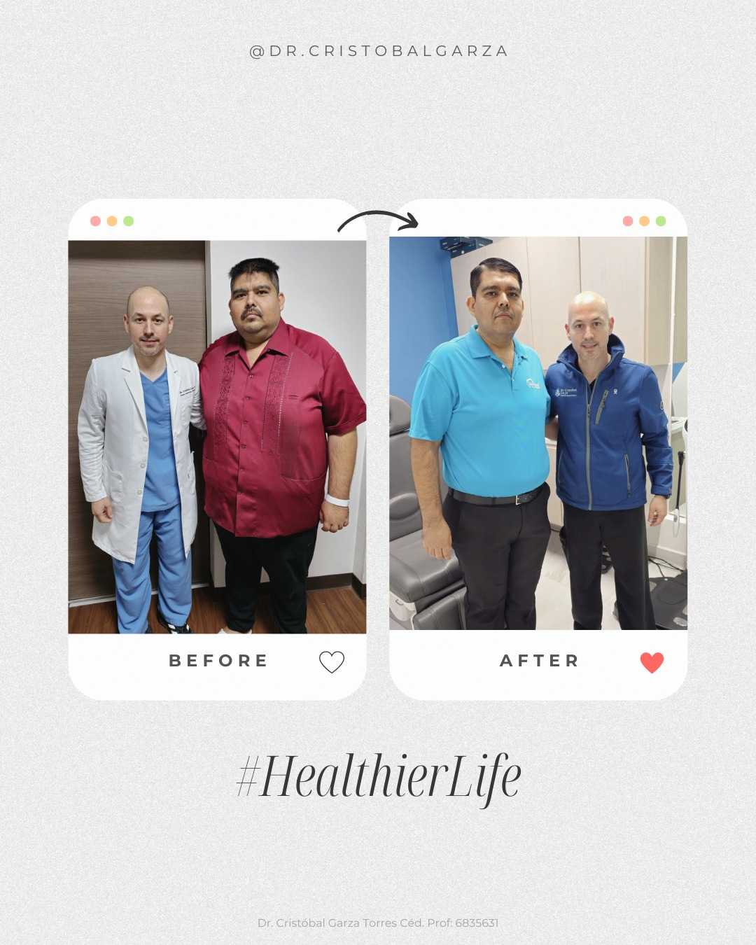 Gastric Revision Surgery Mexico Before After Image
