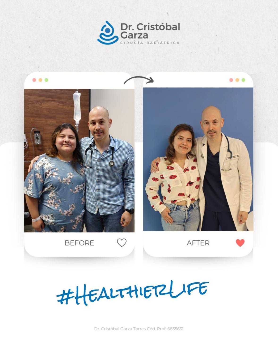 SADI-S Surgery Package in Piedras Negras Mexico Before and After Image