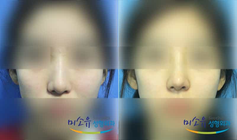 Before and After Images Results of Aesthetic Surgery in Seoul South Korea