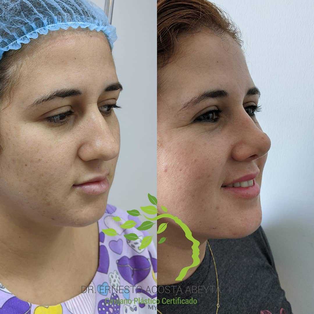 Before and After Rhinoplasty in Merida Mexico