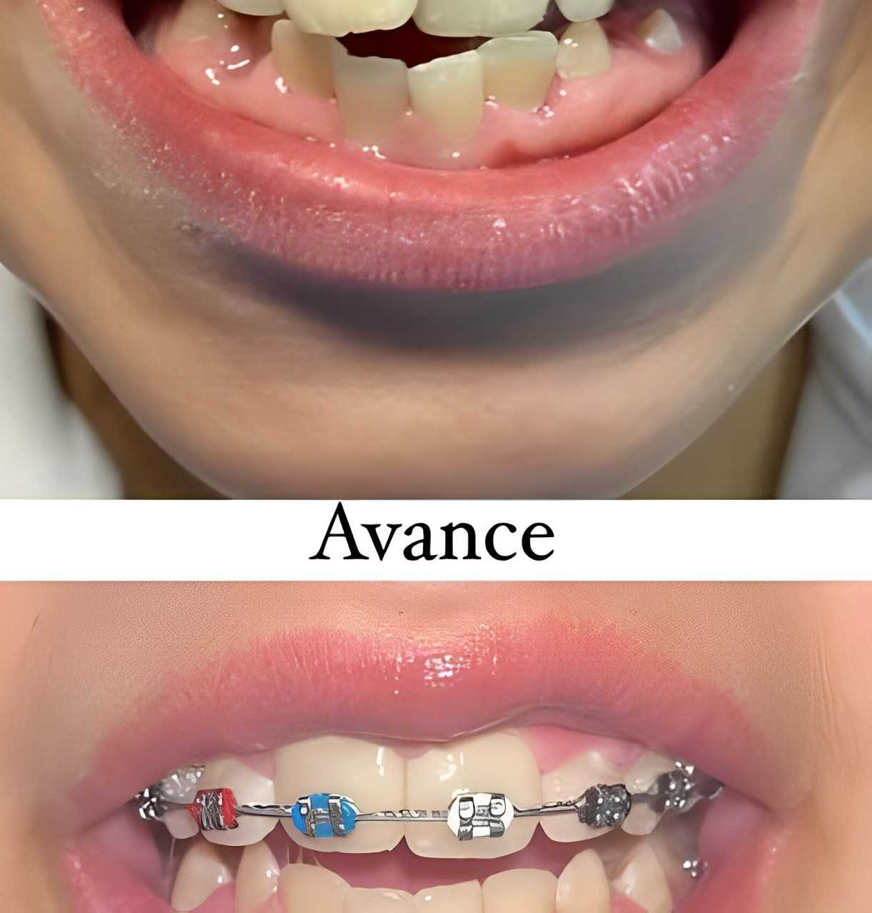 Before and After Dental Braces in Los Algodones, Mexico