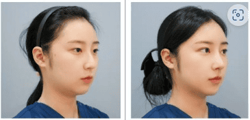 Before After Plastic Surgery in Seoul South Korea