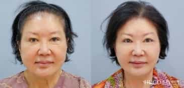 Before After Cosmetic Surgery in Seoul South Korea
