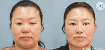 Plastic Surgery in Seoul South Korea Before After 