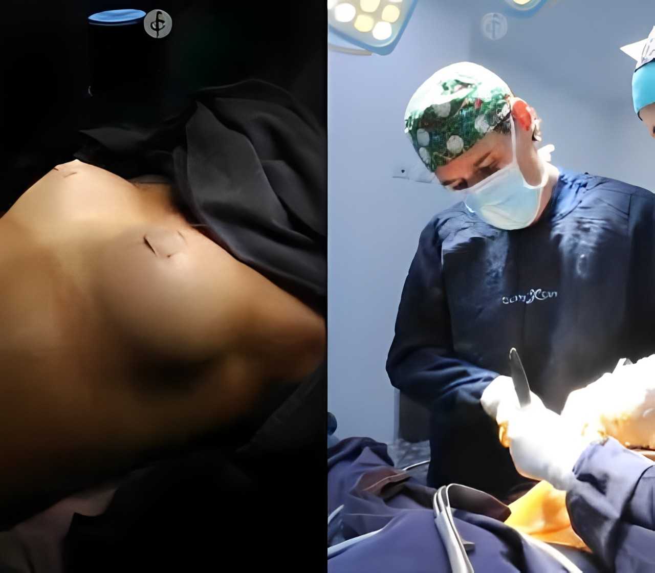 Borstprothesen in Bogota, Colombia