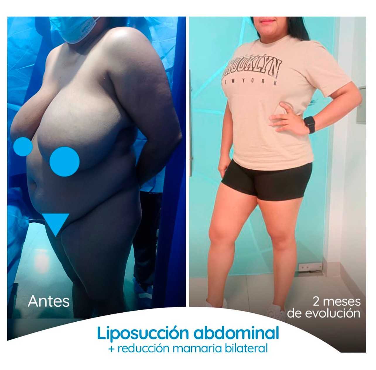 Breast Reduction + Liposuction Colombia