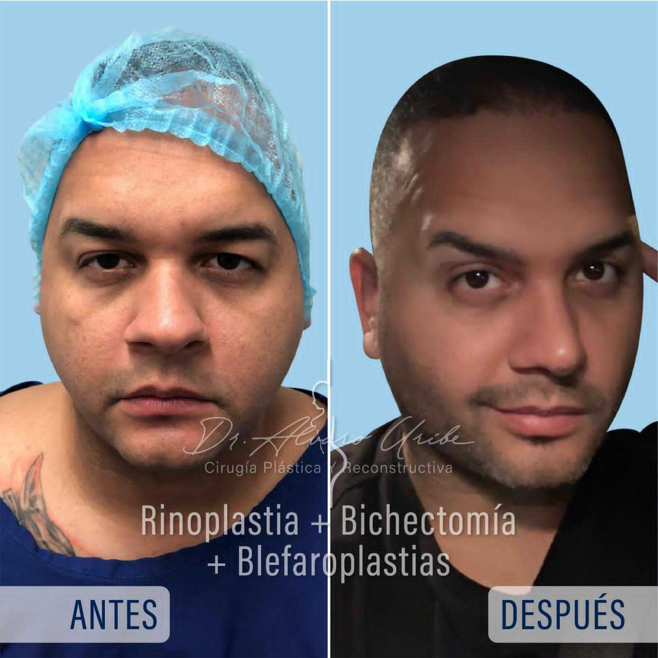 Eyelid Surgery in Barranquilla