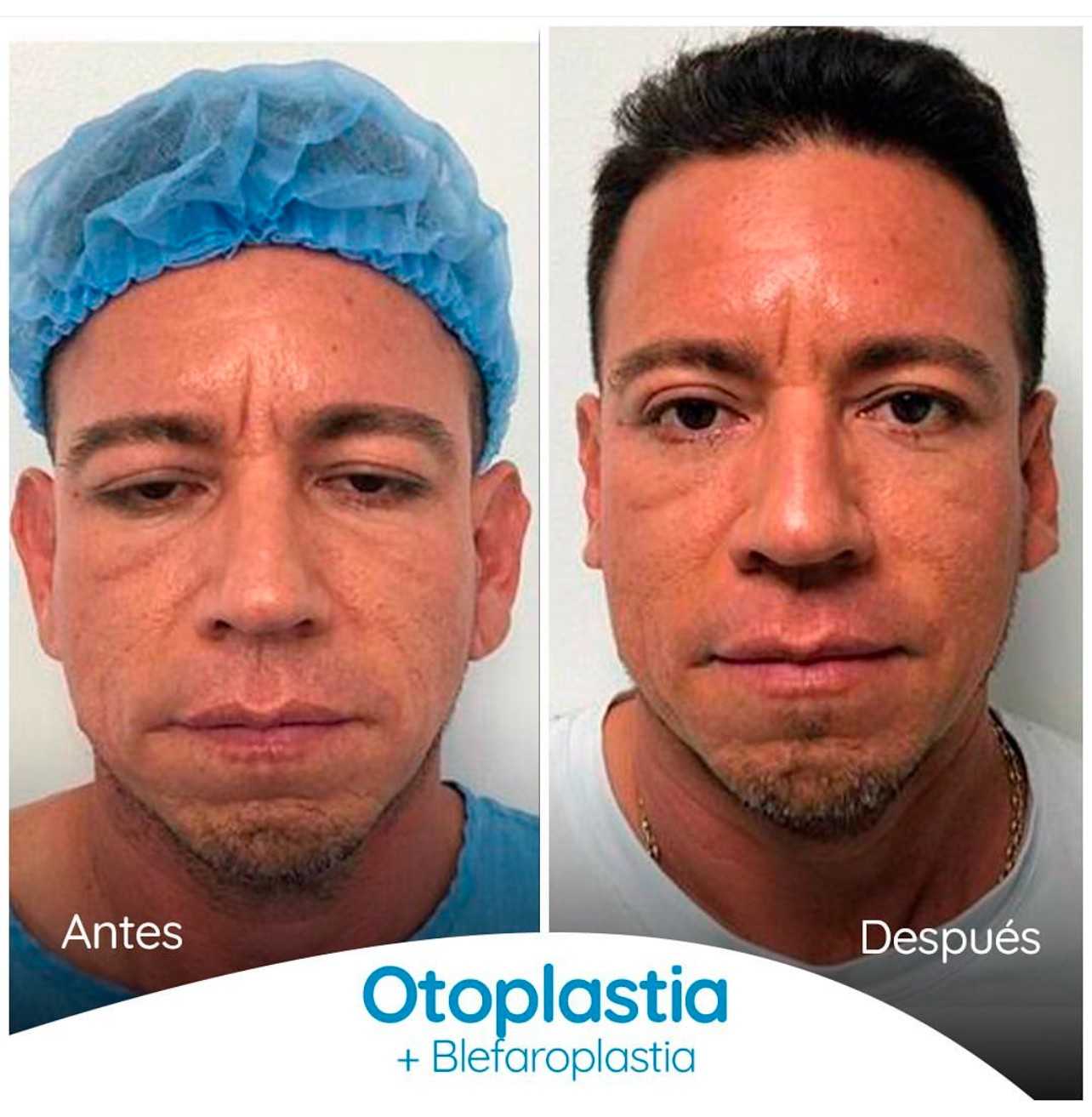 Eyelids and Ears Surgery in Colombia