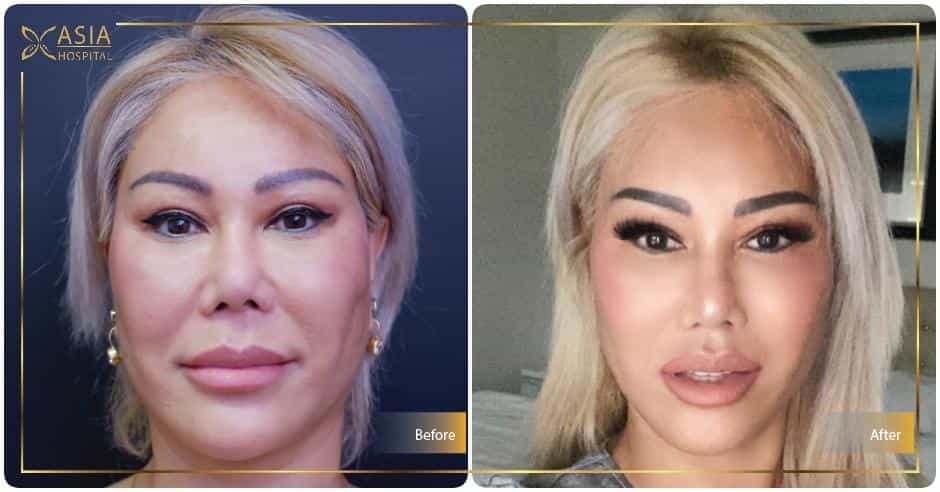 Operasi Pengencangan Wajah di Bangkok, Thailand