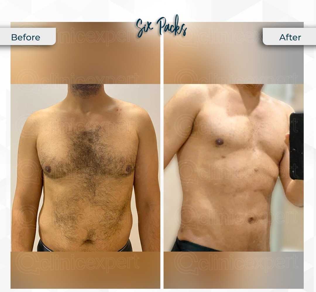 Before and After Image for Abdominoplasty in Istanbul Turkey