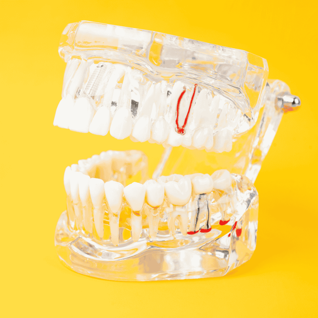 Zygomatic Implants