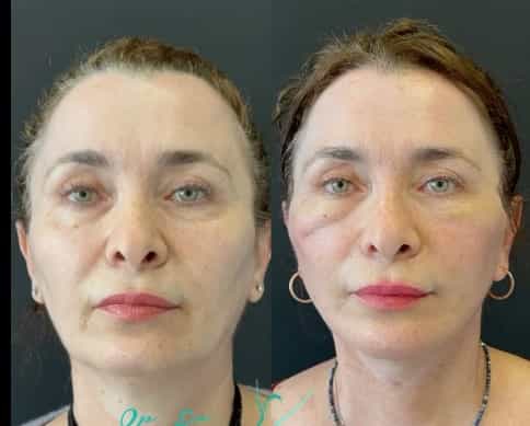 Antalya Facelift Before & After