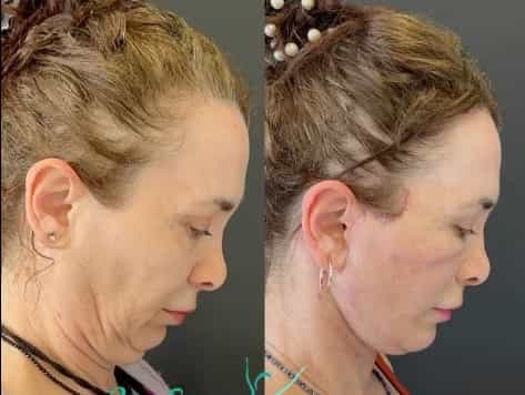 Face Lift Results in Antalya