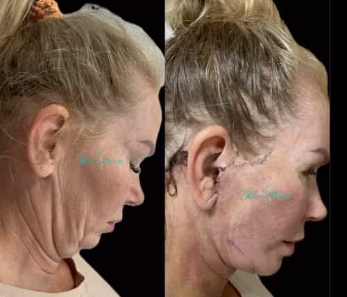 Antalya Facelift Surgery Outcomes