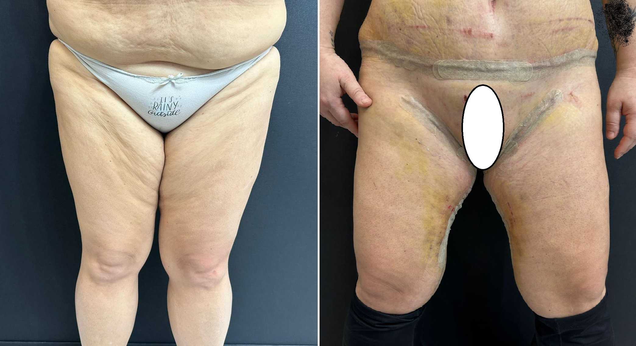 Lifting de muslos en Antalya, Turquía, imagen de antes y después